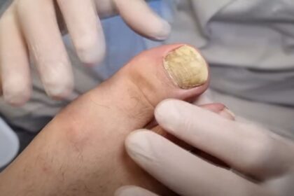 Ongle décollé blanc avec une zone opaque visible sous la lame, observé en gros plan sur un doigt